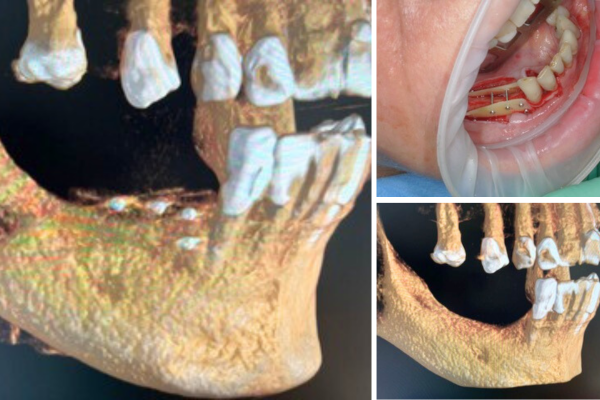 dental future interna rigenerazione chirurgia orale ossea dentale tempi dolore rischi