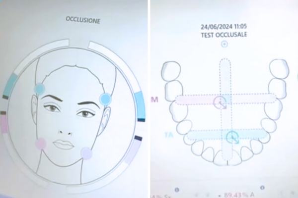 dental future teethan diagnosi bruxismo malocclusione dentale 2